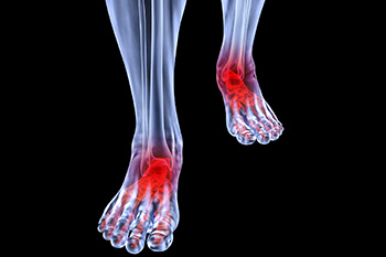 arthritic foot care in the Cherokee County GA: Canton, Holly Springs, Sixes, Kennesaw, Acworth, Bridgemill, Keithsburg, Avery, Buffington, Sutallee, Lebanon, Kellogg Creek, Hickory Flat areas