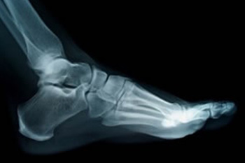 digital x-ray, Award Winning Podiatry Practice in the Cherokee County GA: Canton, Holly Springs, Sixes, Kennesaw, Acworth, Bridgemill, Keithsburg, Avery, Buffington, Sutallee, Lebanon, Kellogg Creek, Hickory Flat areas