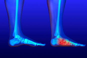 flat feet treatment in the Cherokee County GA: Canton, Holly Springs, Sixes, Kennesaw, Acworth, Bridgemill, Keithsburg, Avery, Buffington, Sutallee, Lebanon, Kellogg Creek, Hickory Flat areas