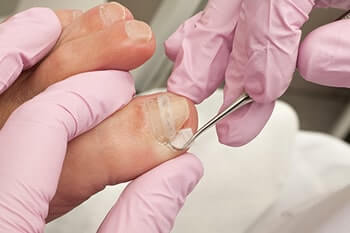 ingrown toenail treatment in the Cherokee County GA: Canton, Holly Springs, Sixes, Kennesaw, Acworth, Bridgemill, Keithsburg, Avery, Buffington, Sutallee, Lebanon, Kellogg Creek, Hickory Flat areas