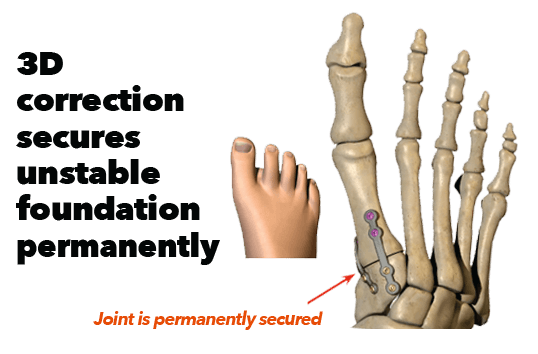 lapiplasty 3d in the Cherokee County GA: Canton, Holly Springs, Sixes, Kennesaw, Acworth, Bridgemill, Keithsburg, Avery, Buffington, Sutallee, Lebanon, Kellogg Creek, Hickory Flat areas