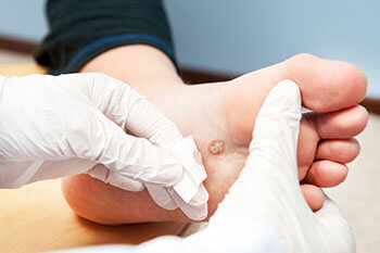 plantar warts treatment in the Cherokee County GA: Canton, Holly Springs, Sixes, Kennesaw, Acworth, Bridgemill, Keithsburg, Avery, Buffington, Sutallee, Lebanon, Kellogg Creek, Hickory Flat areas