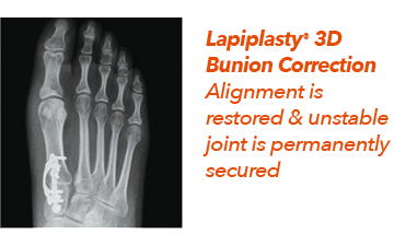 Lapiplasty 3D Bunion Correction in the Cherokee County GA: Canton, Holly Springs, Sixes, Kennesaw, Acworth, Bridgemill, Keithsburg, Avery, Buffington, Sutallee, Lebanon, Kellogg Creek, Hickory Flat areas