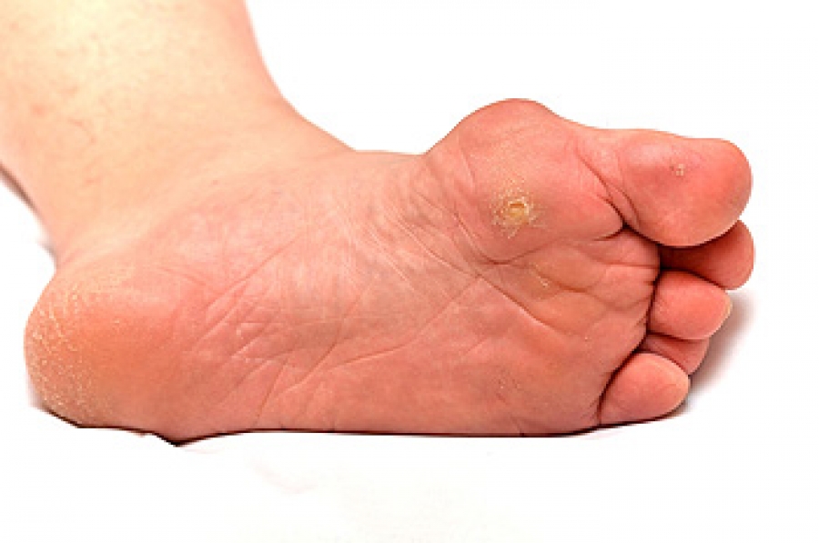 Complications From Untreated Corns on the Feet
