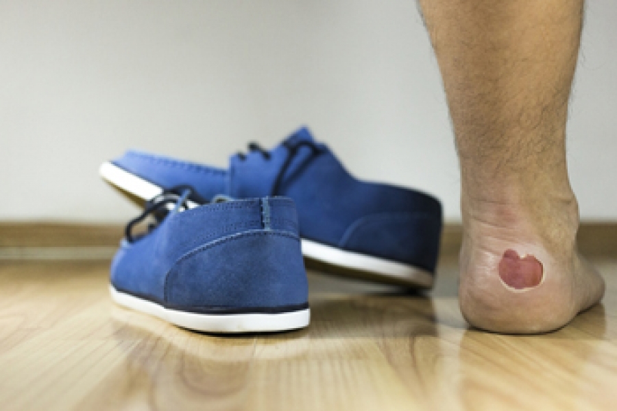 How Can I Prevent a Foot Blister?