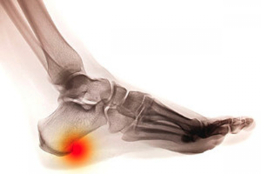 Causes and Risk Factors of Heel Spurs