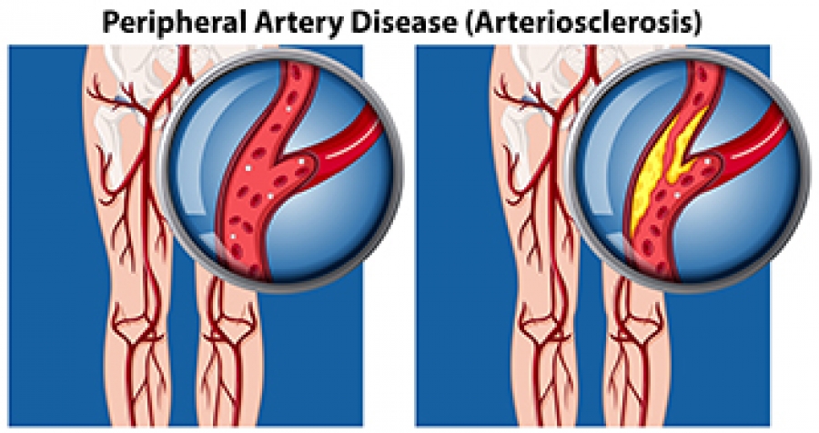 Peripheral Artery Disease Explained
