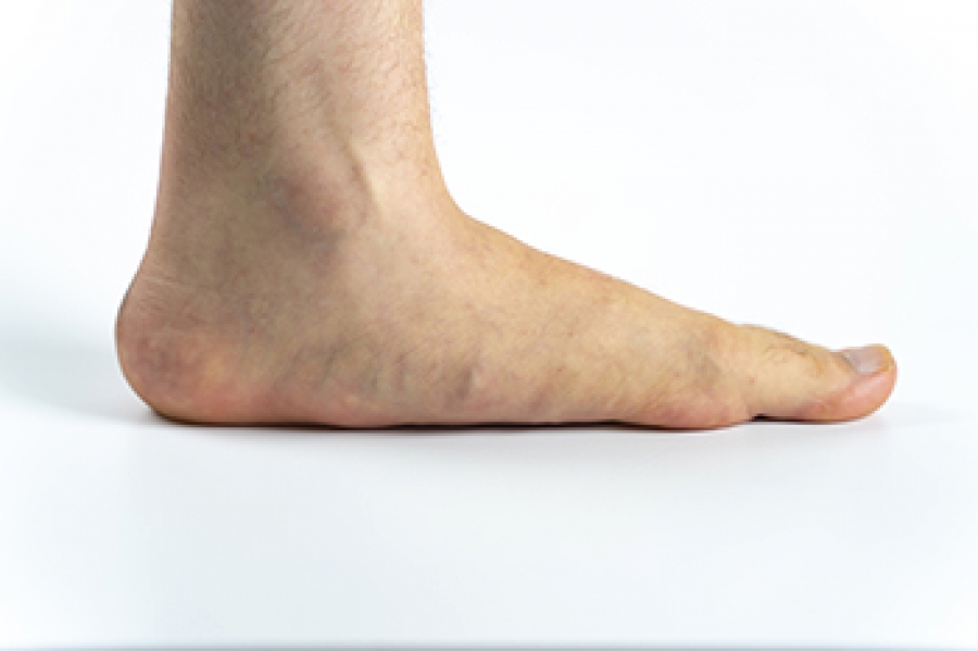 The Benefits of Flat Feet in Athletics
